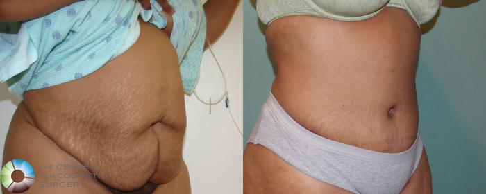 Before & After Tummy Tuck Case 686 View #1 in Denver and Colorado Springs, CO