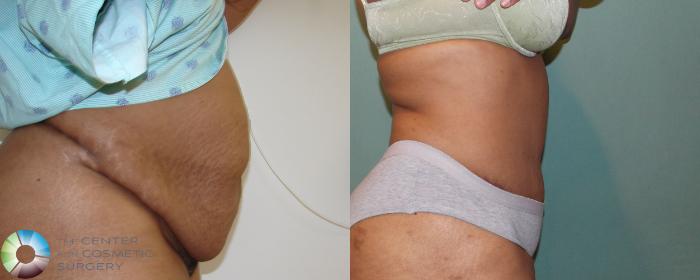 Before & After Tummy Tuck Case 686 View #2 in Denver and Colorado Springs, CO