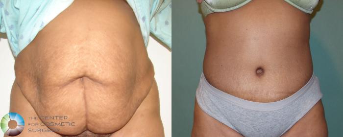 Before & After Tummy Tuck Case 686 View #3 in Denver and Colorado Springs, CO