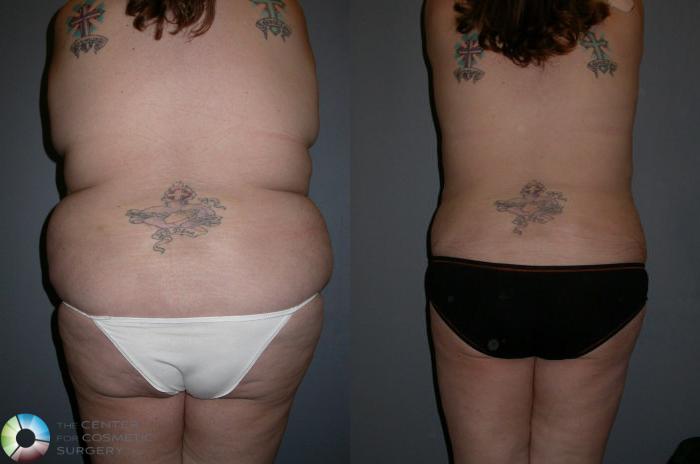 Before & After Tummy Tuck Case 73 View #2 View in Golden, CO