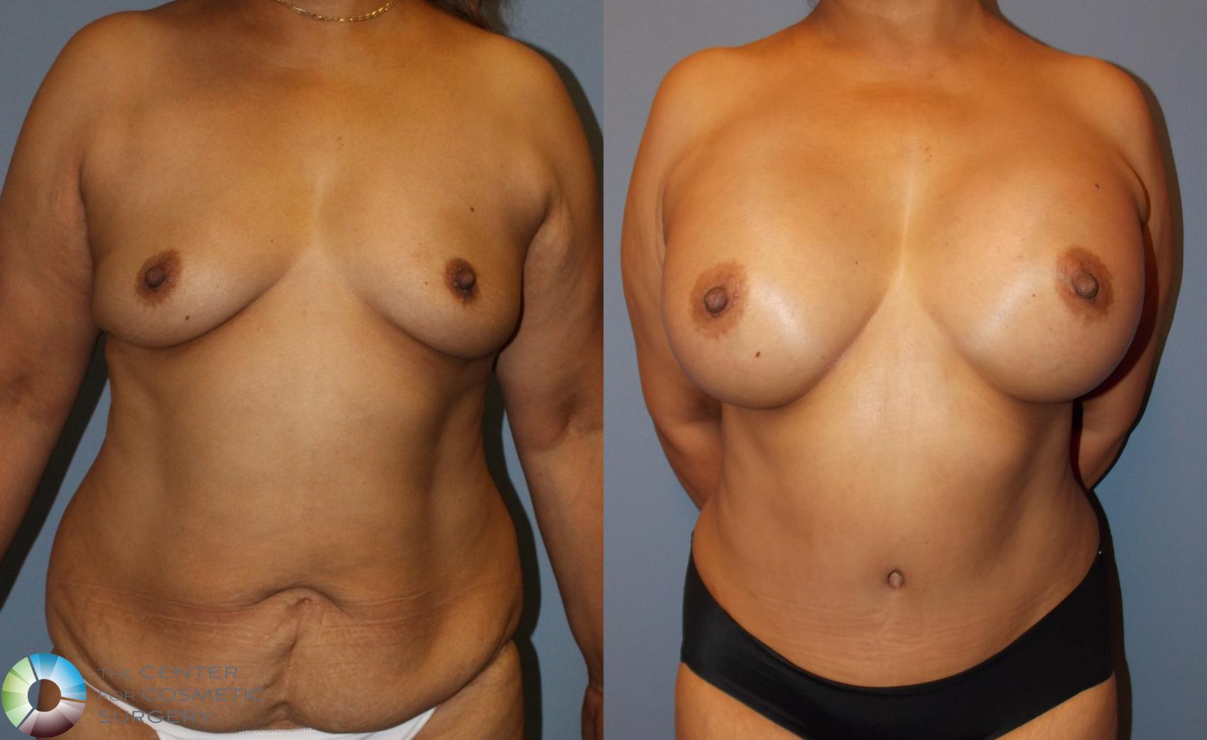 Before & After Tummy Tuck Case 778 View #1 View in Golden, CO