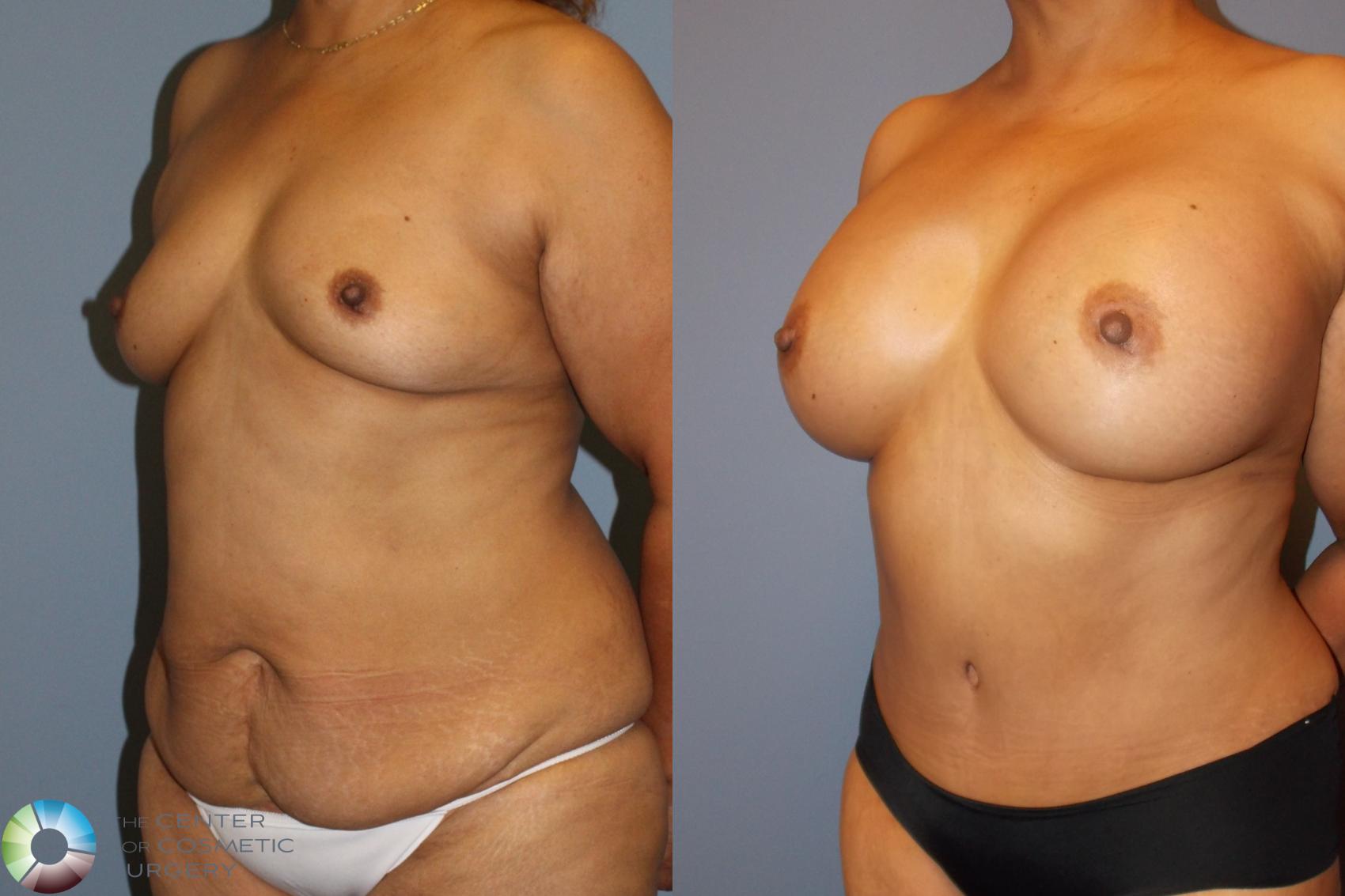 Before & After Tummy Tuck Case 778 View #2 in Denver and Colorado Springs, CO