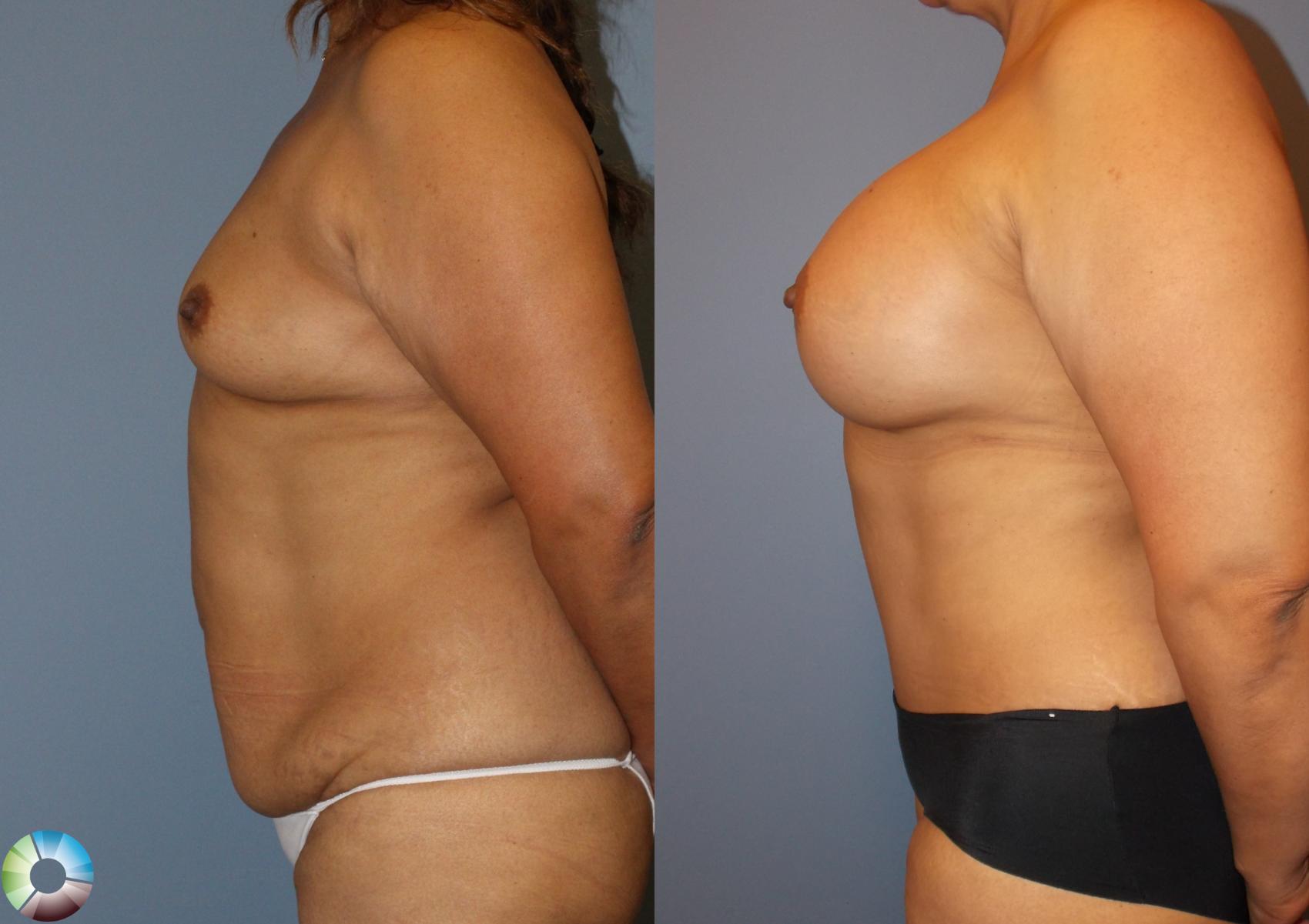 Before & After Tummy Tuck Case 778 View #3 View in Golden, CO