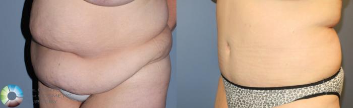 Before & After Tummy Tuck Case 780 View #1 in Denver and Colorado Springs, CO