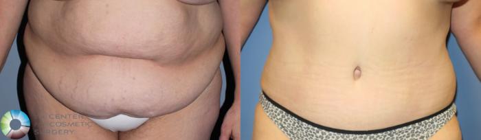 Before & After Tummy Tuck Case 780 View #2 in Denver and Colorado Springs, CO