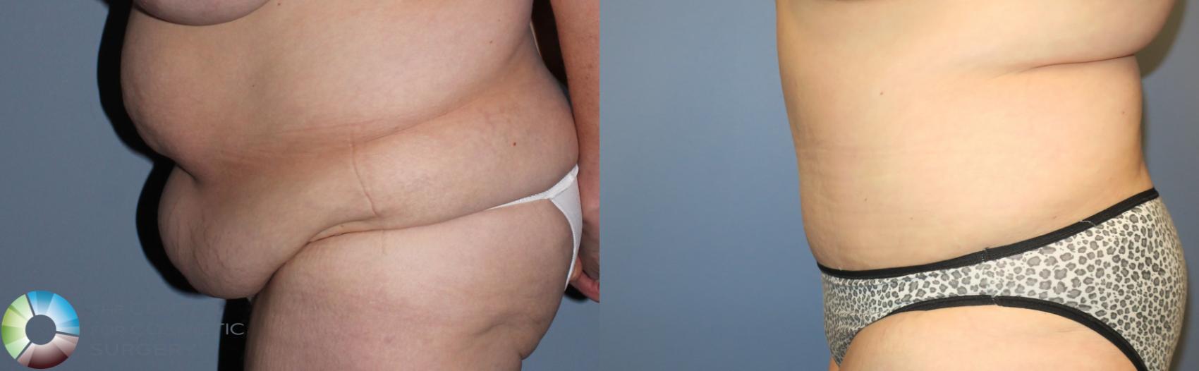 Before & After Tummy Tuck Case 780 View #3 View in Golden, CO