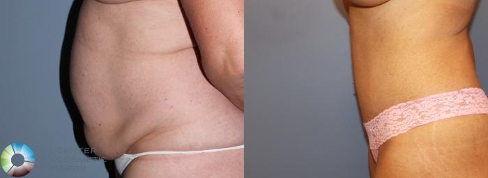 Before & After Tummy Tuck Case 791 View #1 in Denver and Colorado Springs, CO