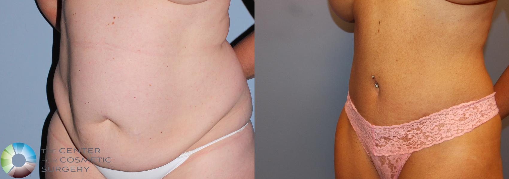Before & After Tummy Tuck Case 791 View #2 View in Denver & Golden, CO