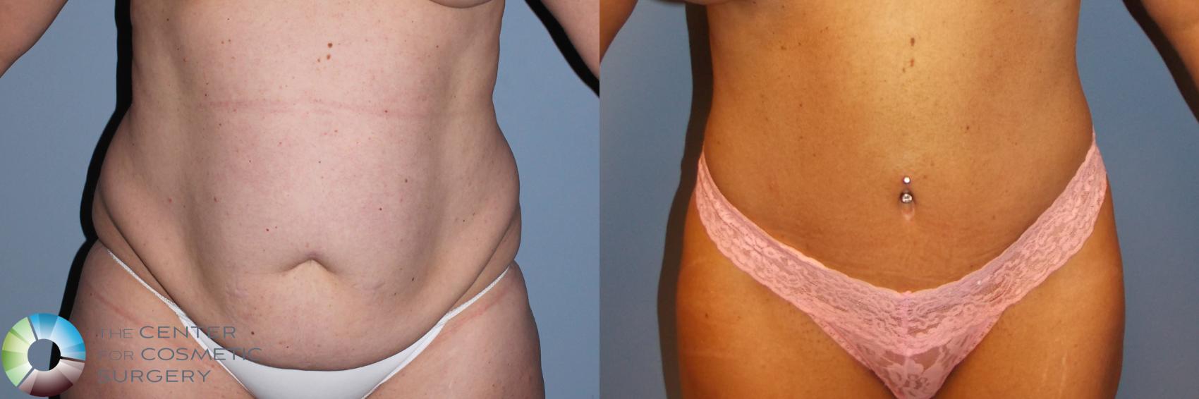 Before & After Tummy Tuck Case 791 View #3 View in Denver & Golden, CO