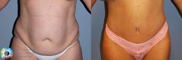 Before & After Tummy Tuck Case 791 View #3 in Denver and Colorado Springs, CO