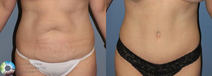 Before & After Tummy Tuck Case 792 View #1 in Denver and Colorado Springs, CO