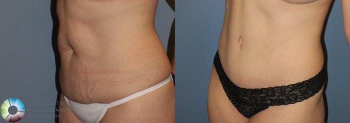 Before & After Tummy Tuck Case 792 View #2 in Denver and Colorado Springs, CO