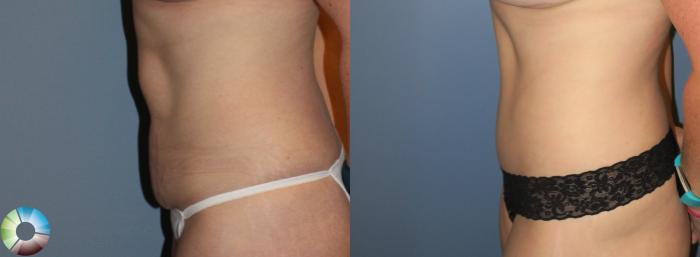 Before & After Tummy Tuck Case 792 View #3 in Denver and Colorado Springs, CO