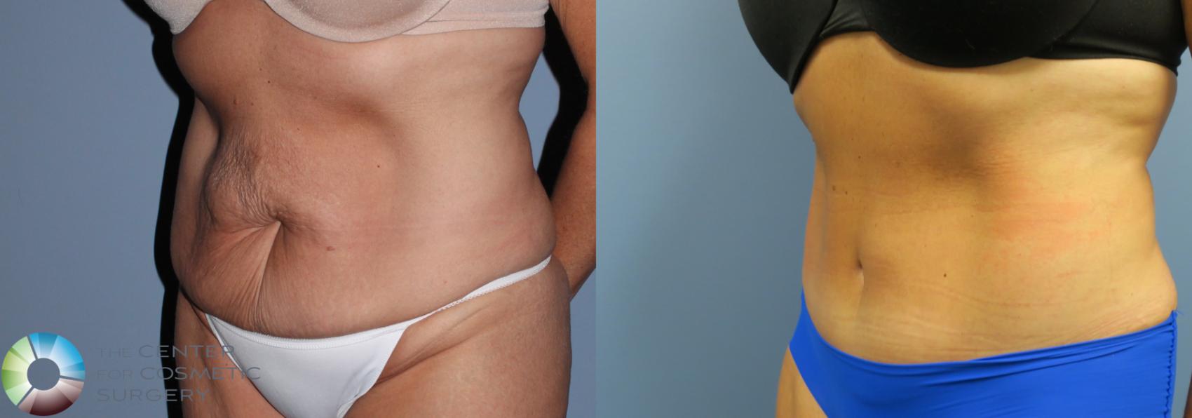 Before & After Tummy Tuck Case 794 View #1 in Denver and Colorado Springs, CO