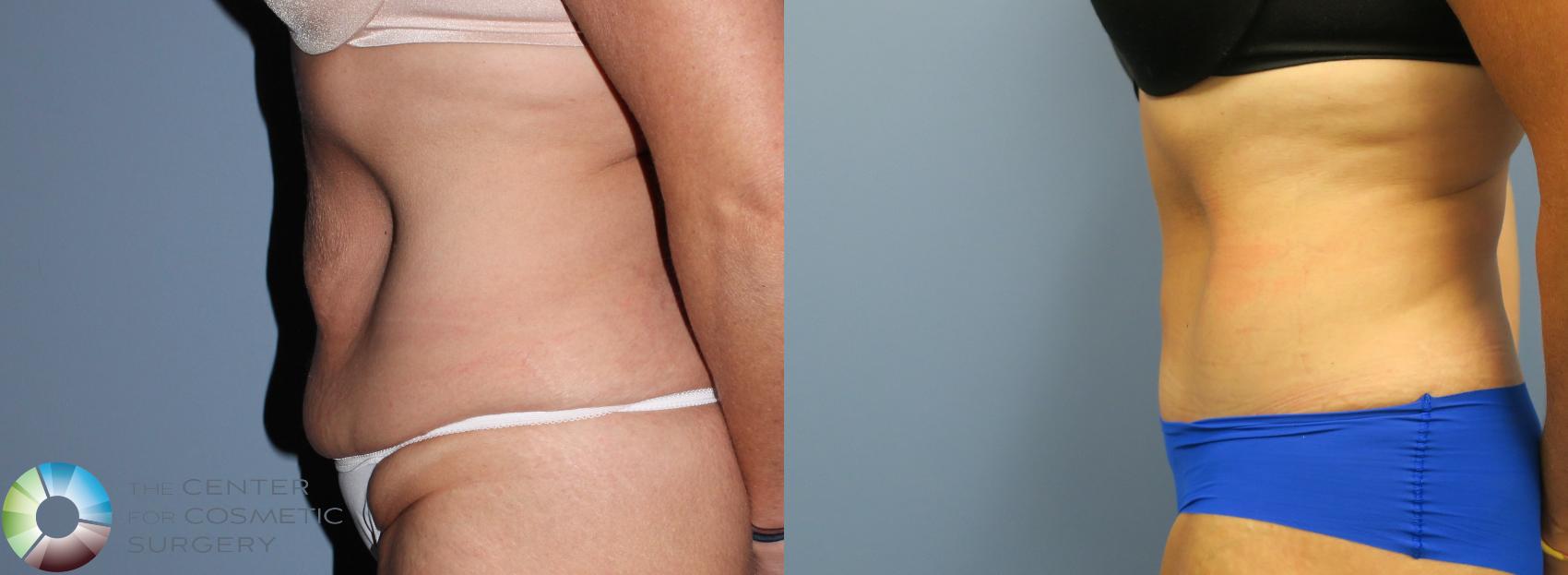 Before & After Tummy Tuck Case 794 View #2 View in Golden, CO