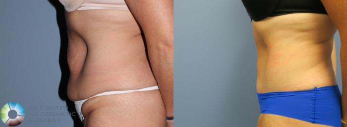 Before & After Tummy Tuck Case 794 View #2 View in Golden, CO