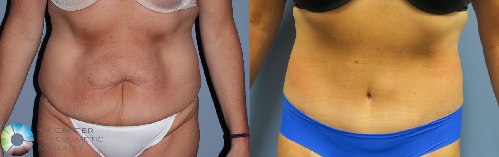 Before & After Tummy Tuck Case 794 View #3 View in Golden, CO
