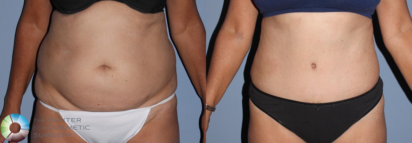 Before & After Tummy Tuck Case 795 View #1 in Denver and Colorado Springs, CO