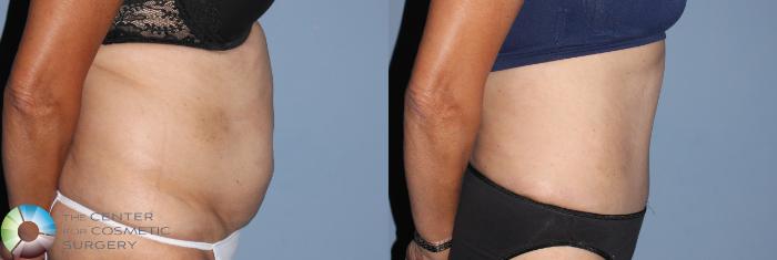 Before & After Tummy Tuck Case 795 View #2 View in Golden, CO