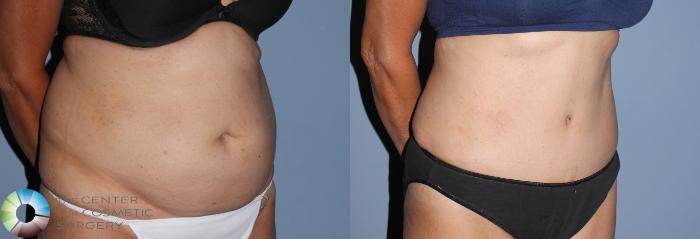 Before & After Tummy Tuck Case 795 View #3 View in Golden, CO
