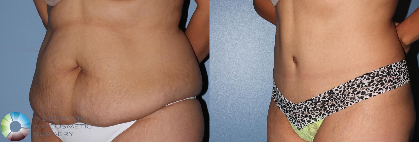 Before & After Tummy Tuck Case 798 View #1 in Denver and Colorado Springs, CO