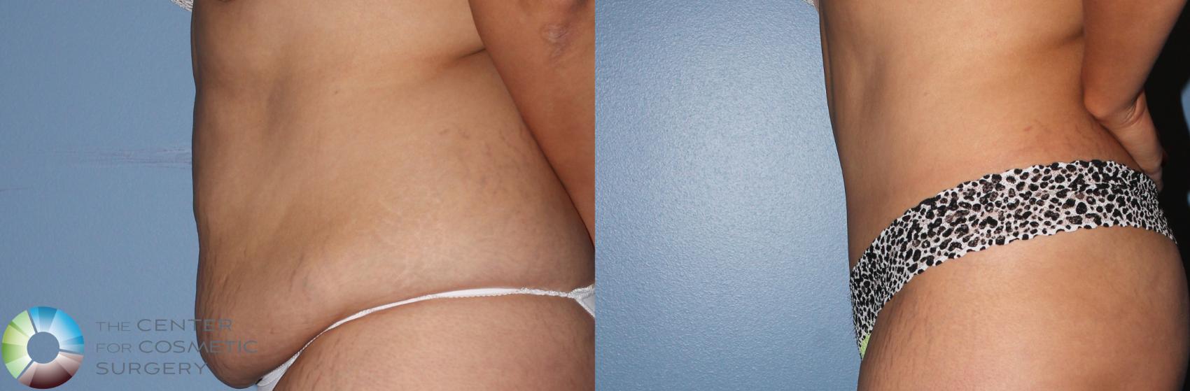 Before & After Tummy Tuck Case 798 View #2 in Denver and Colorado Springs, CO