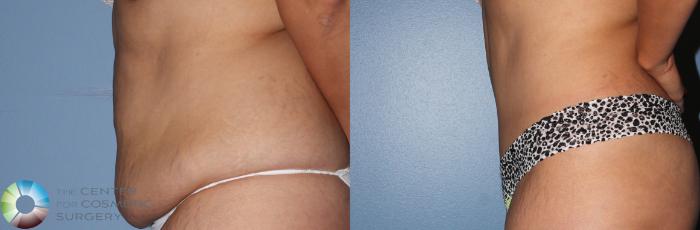 Before & After Tummy Tuck Case 798 View #2 View in Golden, CO