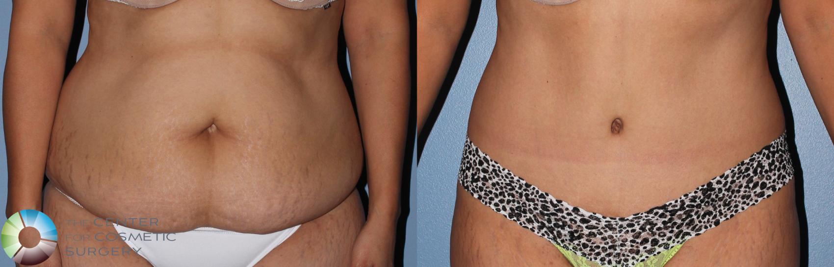 Before & After Tummy Tuck Case 798 View #3 in Denver and Colorado Springs, CO