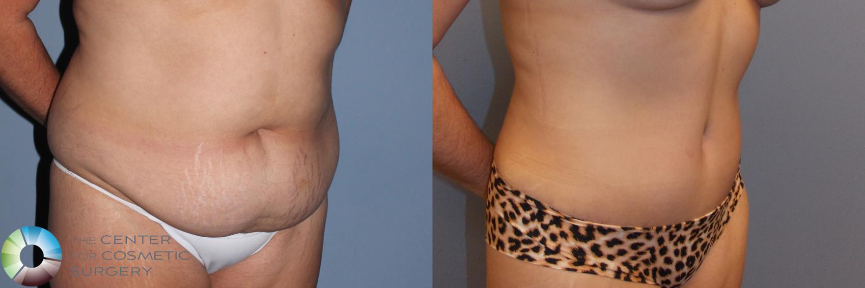 Before & After Tummy Tuck Case 799 View #1 in Denver and Colorado Springs, CO