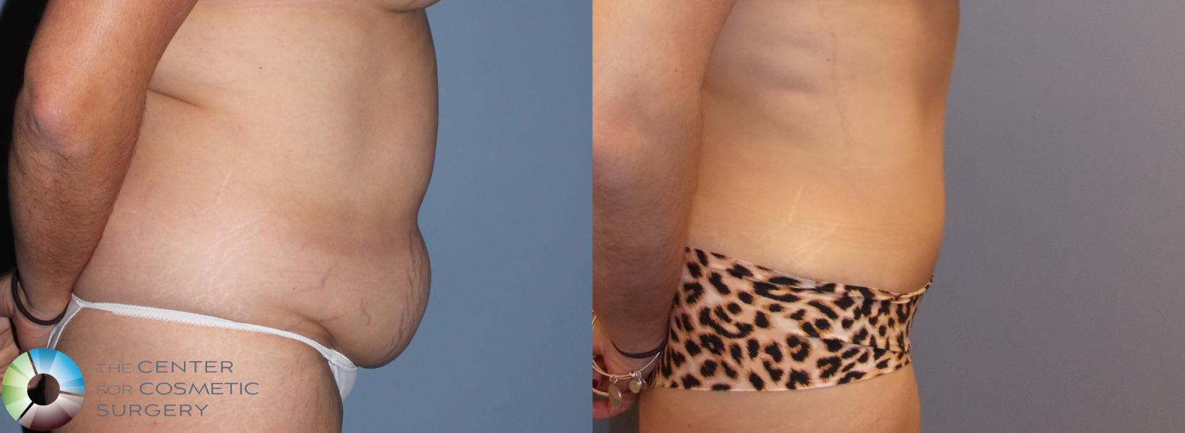 Before & After Tummy Tuck Case 799 View #2 in Denver and Colorado Springs, CO