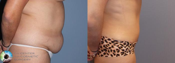 Before & After Tummy Tuck Case 799 View #2 in Denver and Colorado Springs, CO