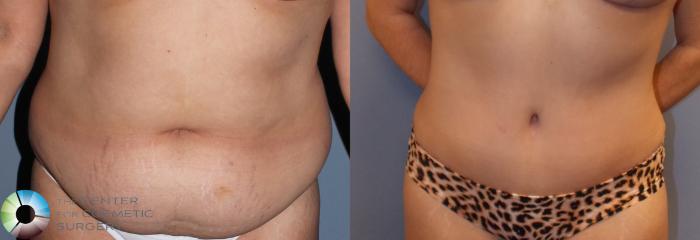 Before & After Tummy Tuck Case 799 View #3 in Denver and Colorado Springs, CO