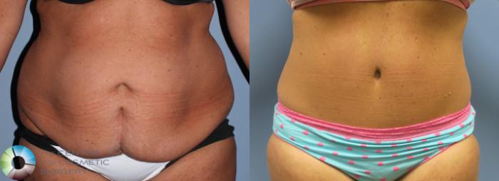 Before & After Tummy Tuck Case 800 View #1 View in Golden, CO