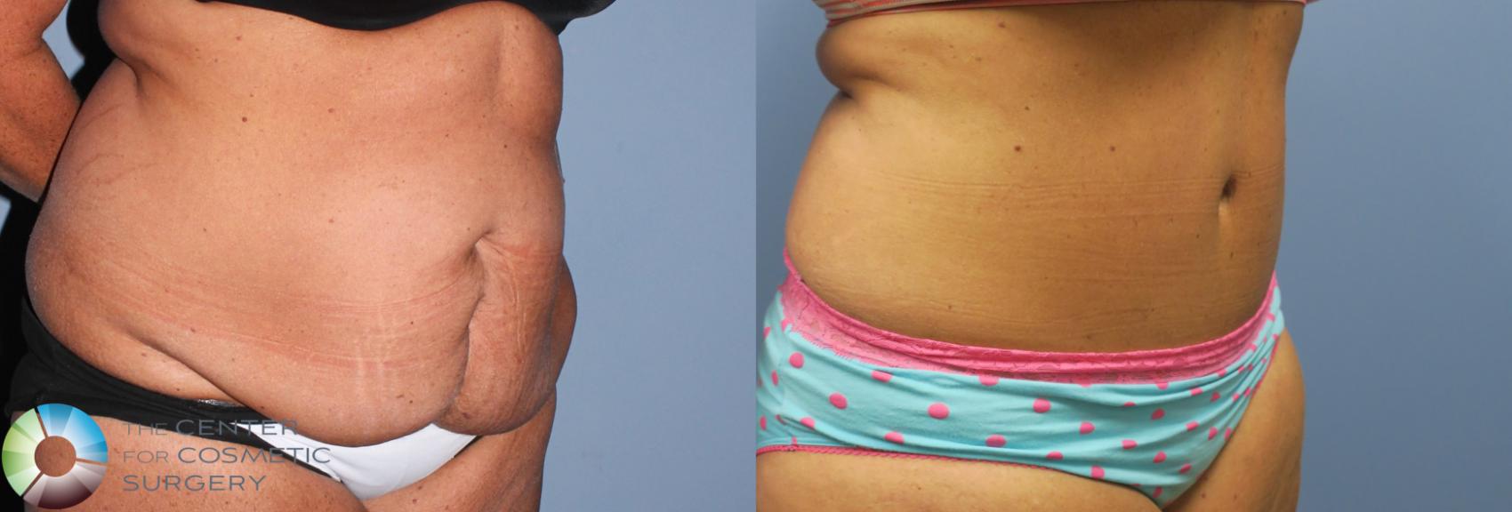 Before & After Tummy Tuck Case 800 View #3 in Denver and Colorado Springs, CO