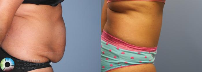 Before & After Tummy Tuck Case 800 View #4 View in Golden, CO