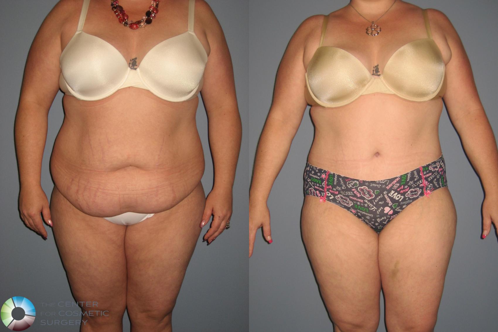 Before & After Tummy Tuck Case 845 View #1 in Denver and Colorado Springs, CO