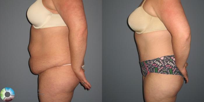 Before & After Tummy Tuck Case 845 View #2 View in Golden, CO