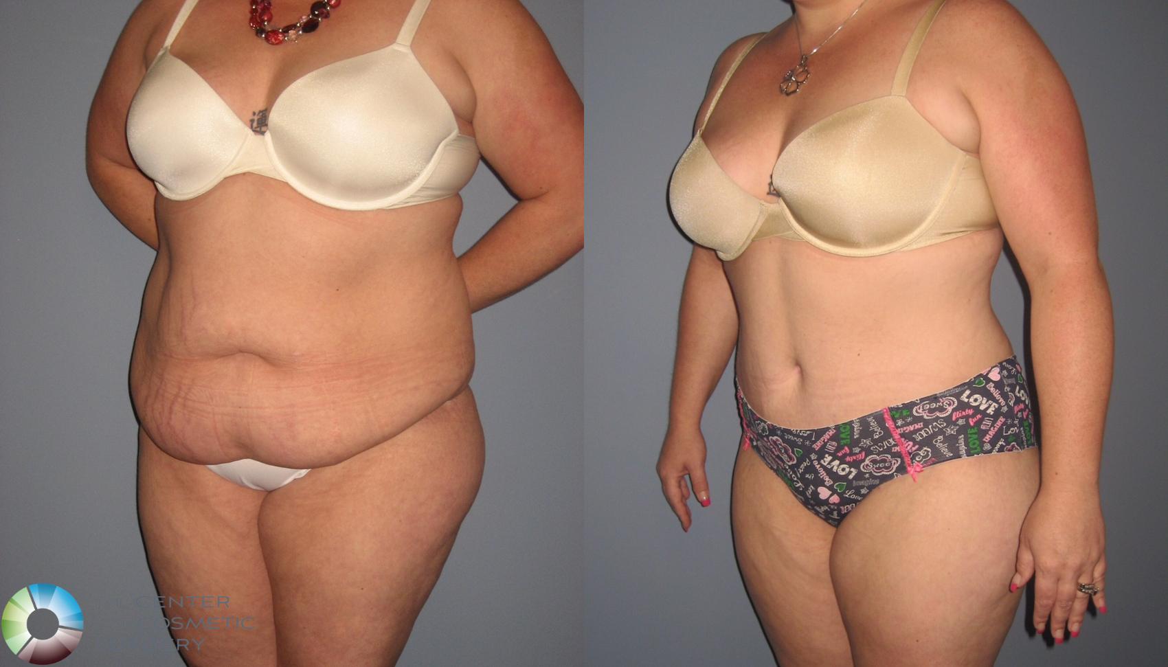 Before & After Tummy Tuck Case 845 View #3 View in Golden, CO
