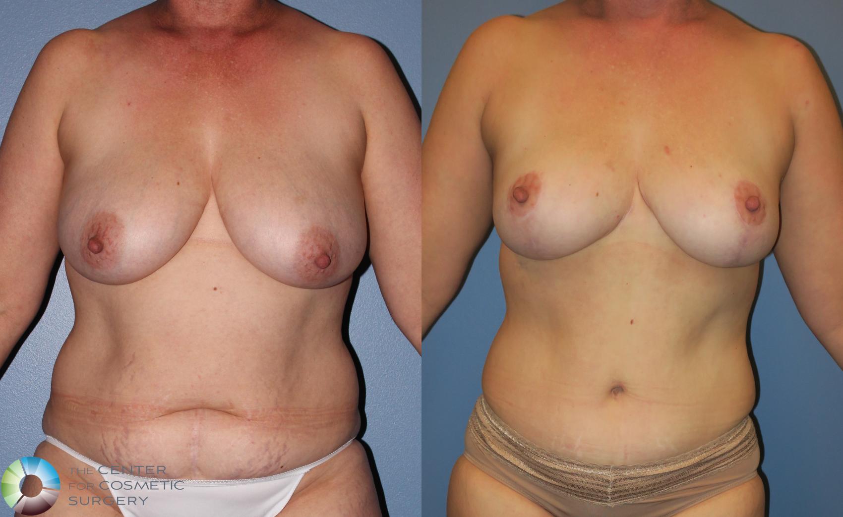 Before & After Tummy Tuck Case 851 View #1 in Denver, CO