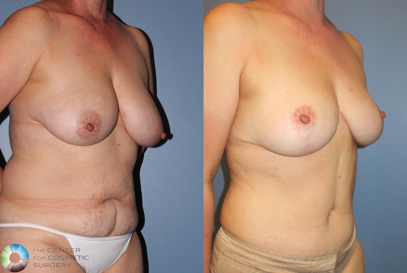Before & After Tummy Tuck Case 851 View #2 in Denver and Colorado Springs, CO