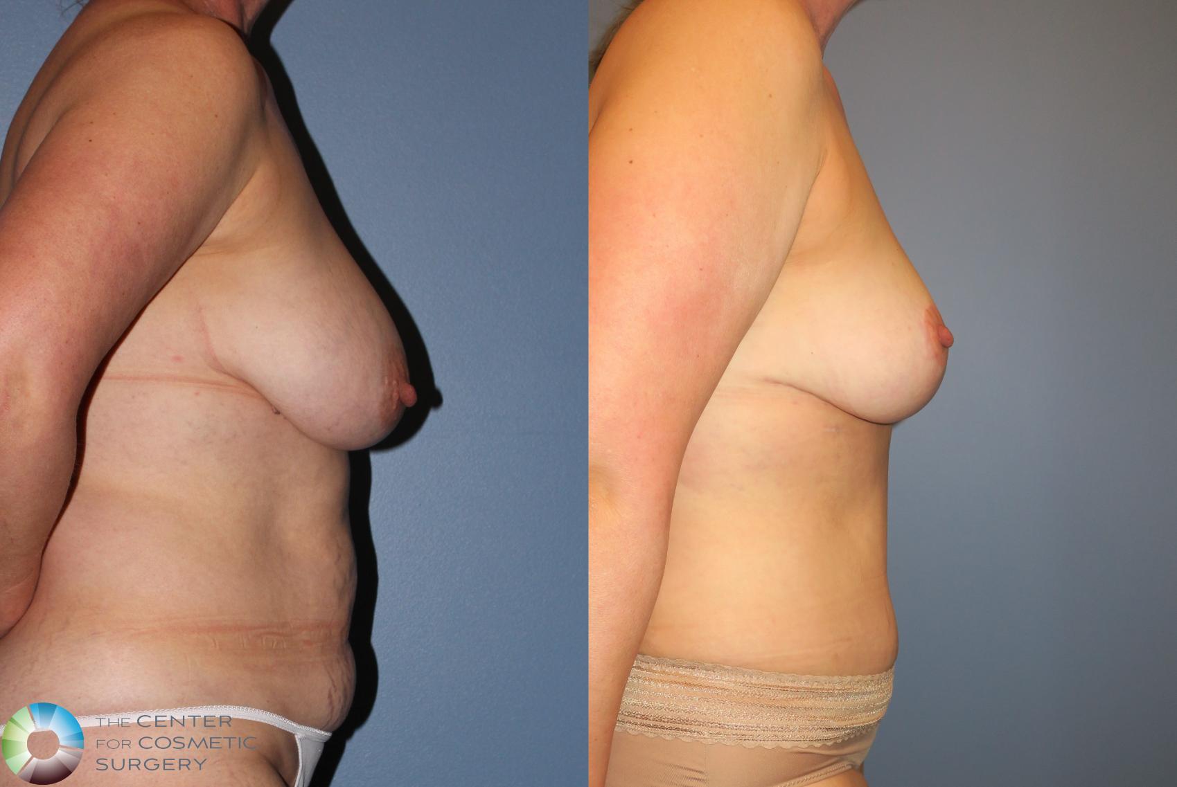 Before & After Tummy Tuck Case 851 View #3 in Denver and Colorado Springs, CO