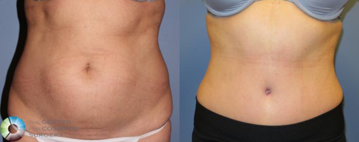 Before & After Tummy Tuck Case 853 View #1 in Denver and Colorado Springs, CO