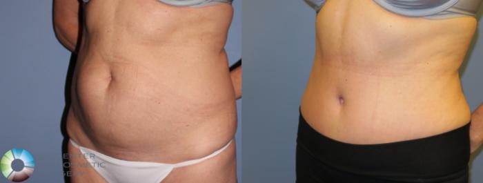 Before & After Tummy Tuck Case 853 View #2 in Denver and Colorado Springs, CO