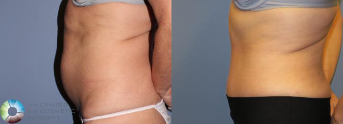 Before & After Tummy Tuck Case 853 View #3 in Denver and Colorado Springs, CO