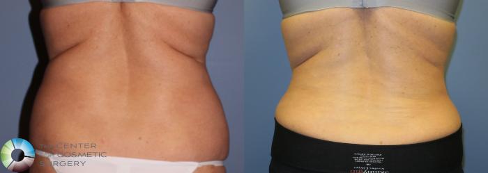 Before & After Tummy Tuck Case 853 View #4 in Denver and Colorado Springs, CO