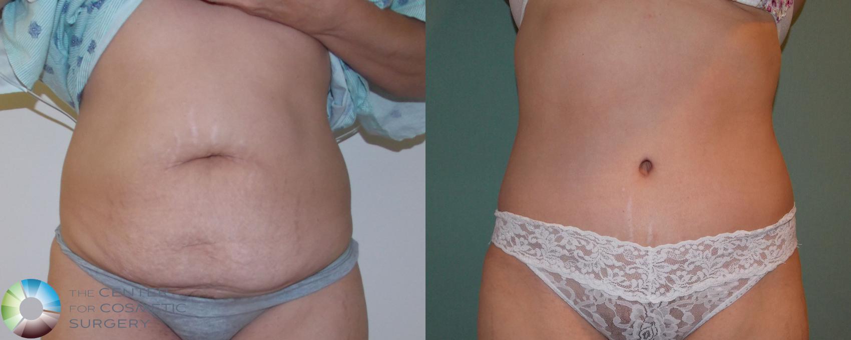 Before & After Tummy Tuck Case 864 View #1 View in Golden, CO