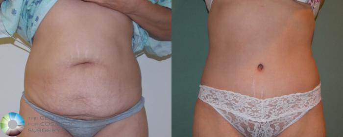Before & After Tummy Tuck Case 864 View #1 in Denver and Colorado Springs, CO