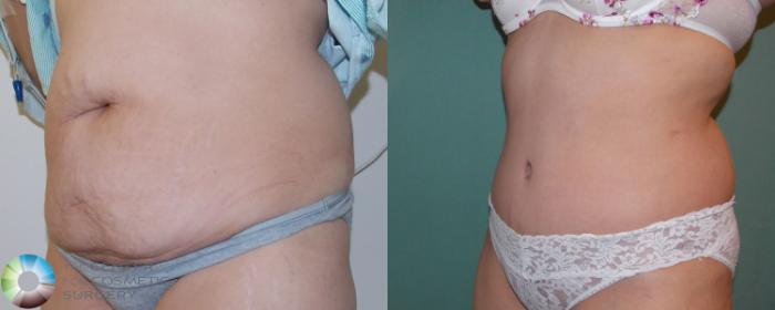 Before & After Tummy Tuck Case 864 View #2 in Denver and Colorado Springs, CO