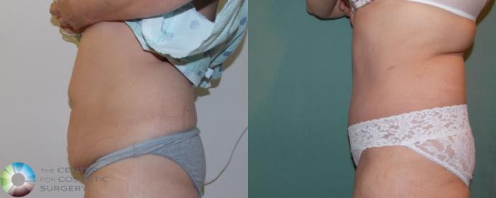 Before & After Tummy Tuck Case 864 View #3 in Denver and Colorado Springs, CO