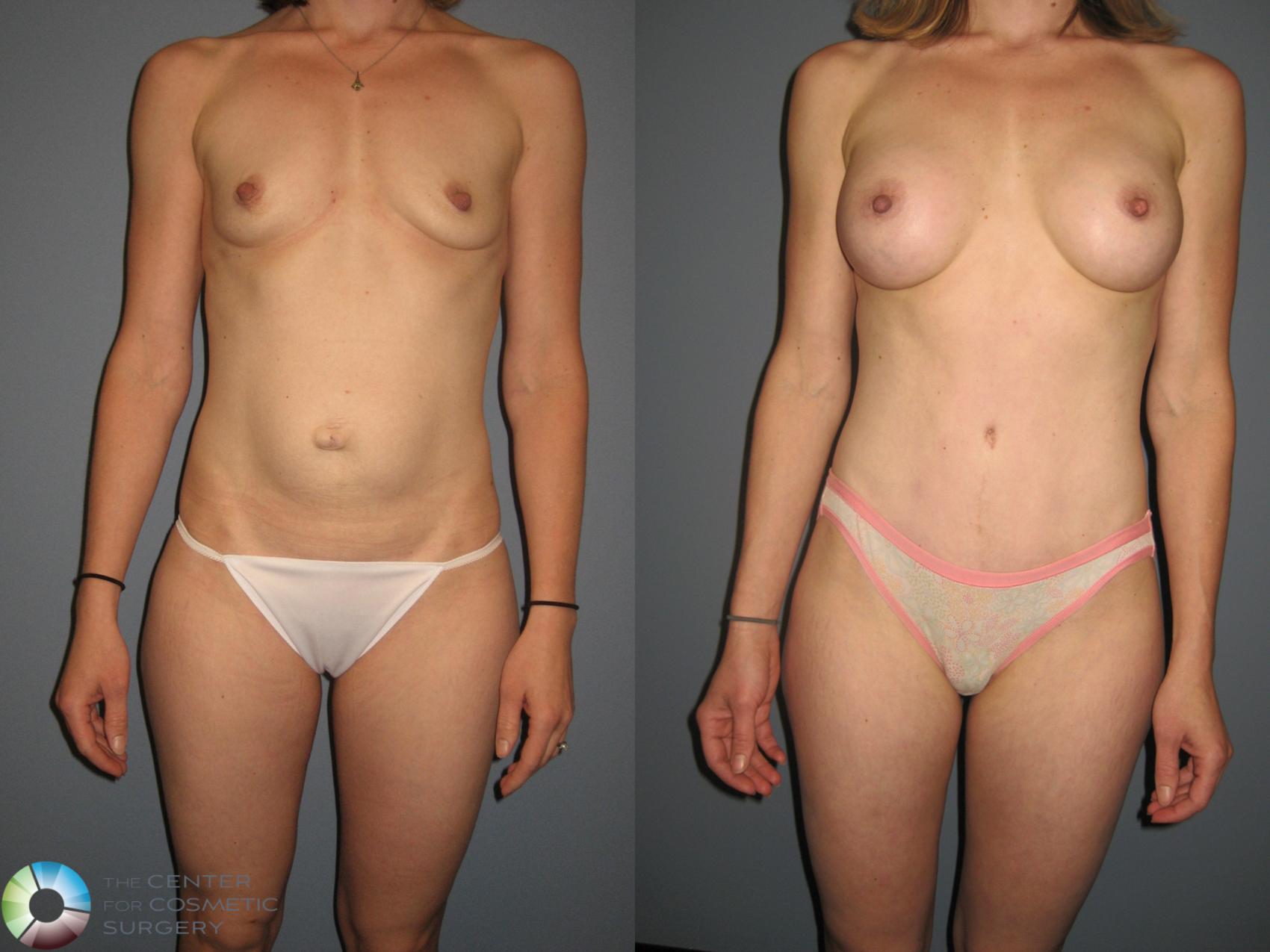 Before & After Tummy Tuck Case 877 View #2 in Denver and Colorado Springs, CO